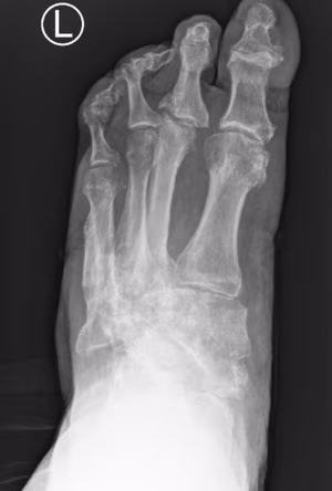 Charcot