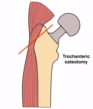 trochanteric osteotomy