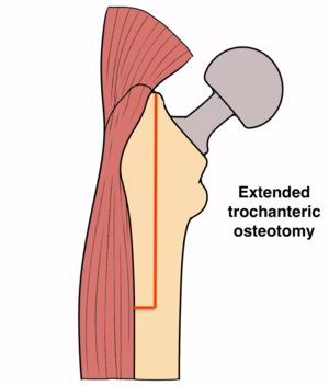 trochanteric osteotomy
