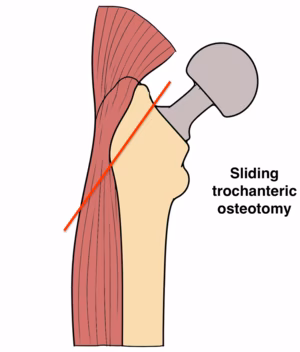 trochanteric osteotomy