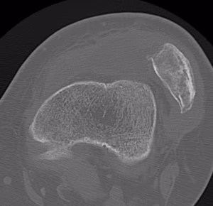 patella