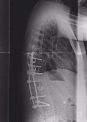 Congential kyphosis