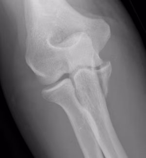 coronoid