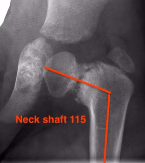 Neck shaft