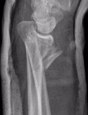 ulna styloid