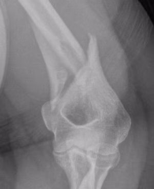 Distal 1/3