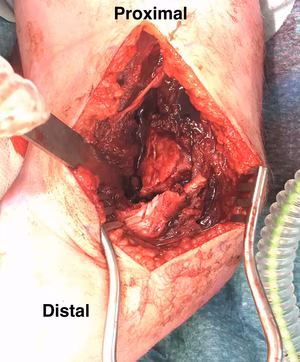 Disp ORIF 1