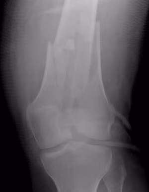 Dist femur