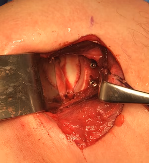allograft