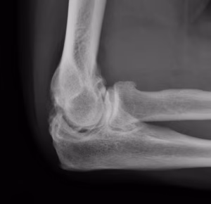 Elbow OA