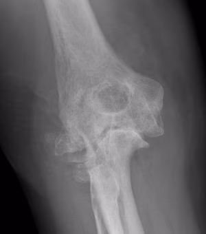 Elbow RA 1