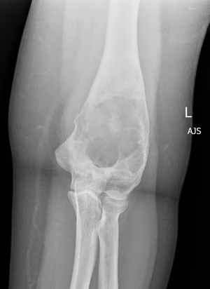 FD Humerus 1