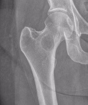 Femur met