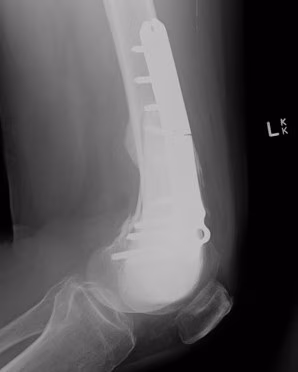 GCT femur 2