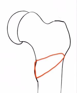 Osteotomy