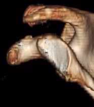Glenoid