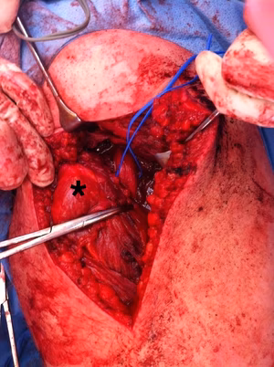 Hamstring nerve