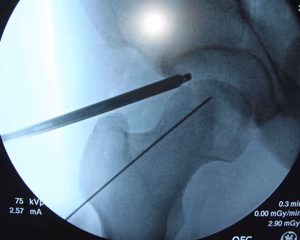 Hip mid anterior