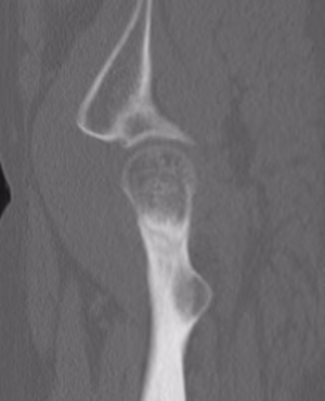 Hip stress CT