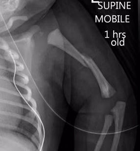 humerus fracture
