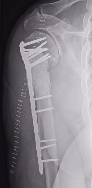 MM Humerus post op