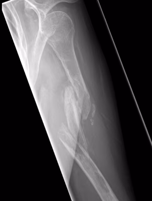 Humerus nonunion