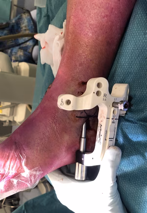 Fibular nail