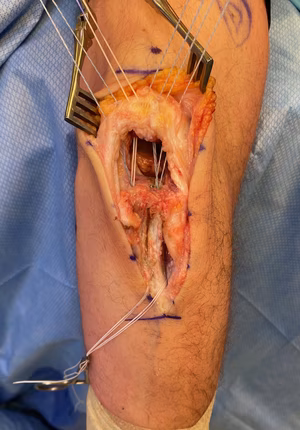 Triceps tear 1