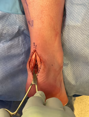 Achilles tendinop