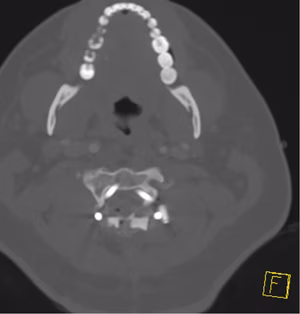 Occ condyle Type II