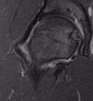Bone marrow edema