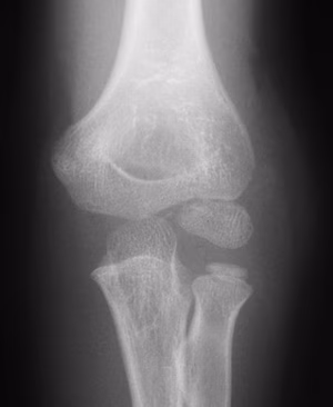 Mildly displaced lateral condyle