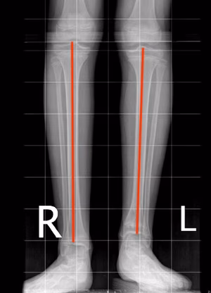 Short tibia