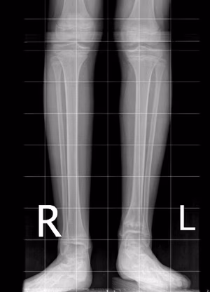 Short tibia