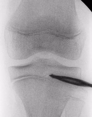 epiphysiodesis