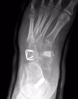metatarsus varus surg