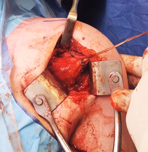 Open shoulder plic