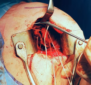 open capsular plication