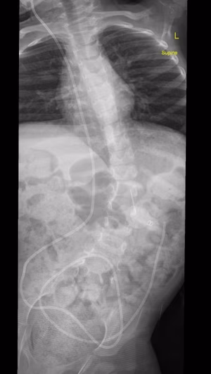 NM scoliosis