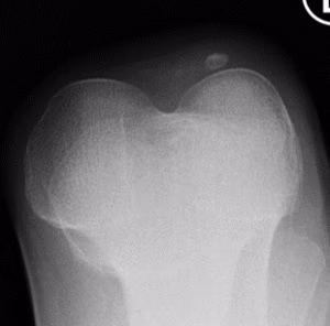 Nail patella syndrome
