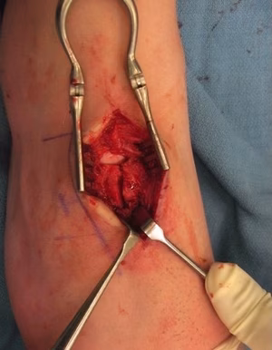 Nav fracture