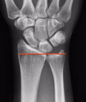 ulna