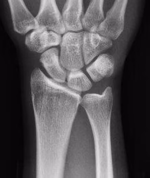 ulna