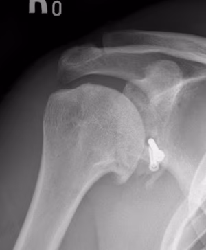 resorption