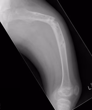 OI femur