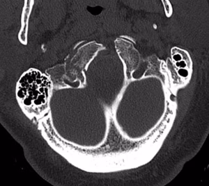Occ condyle Type II