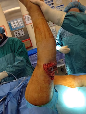Open Knee Dislocation