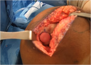 OCA knee 2