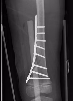 dis femur
