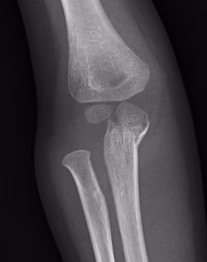 Lateral Mon 1